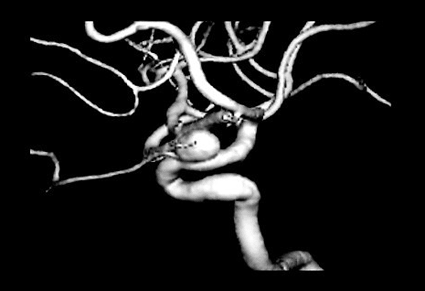 Image: An aneurysm of the internal carotid artery near the origin of the ophthalmic artery (Photo courtesy of Neil Borden / SPL).